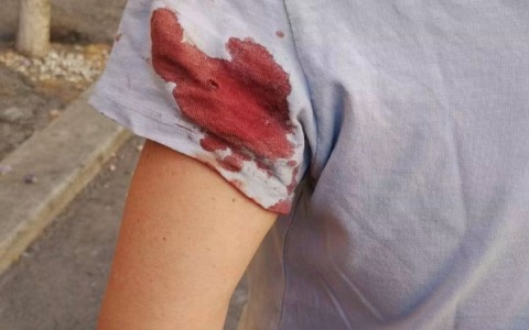 Prati, donna ferita da un piombino: almeno sette episodi